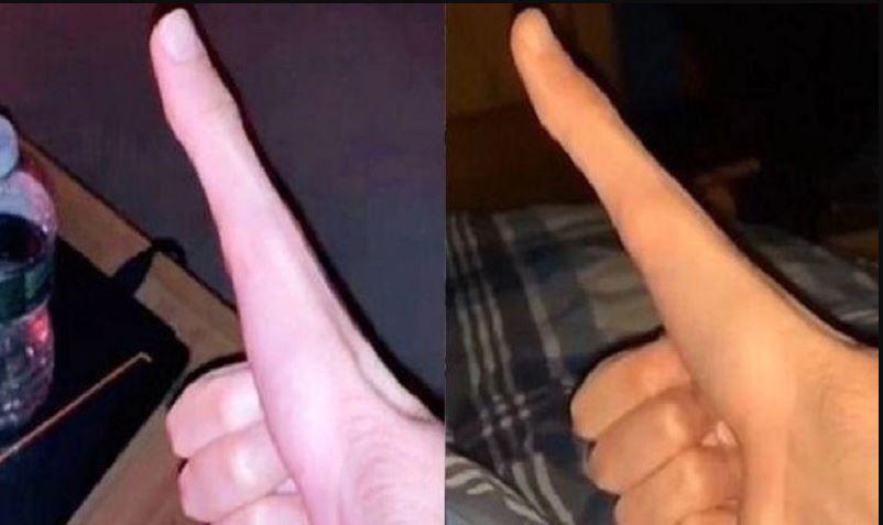 Student with 5-inch-long thumb goes viral